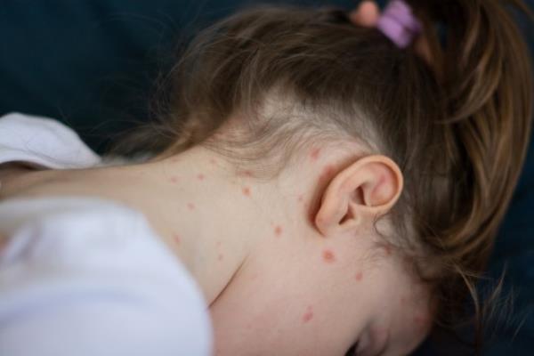 Children tend to co<em></em>ntract measles more than adults (Picture: Getty Images/iStockphoto)