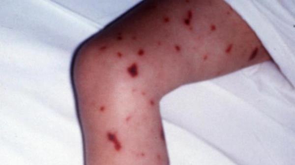 Meningococcal meningitis infection - rash. 28/2/99